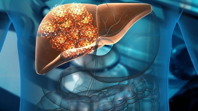 La hepatitis fulminante fue la primera causa de trasplante hepático en el país