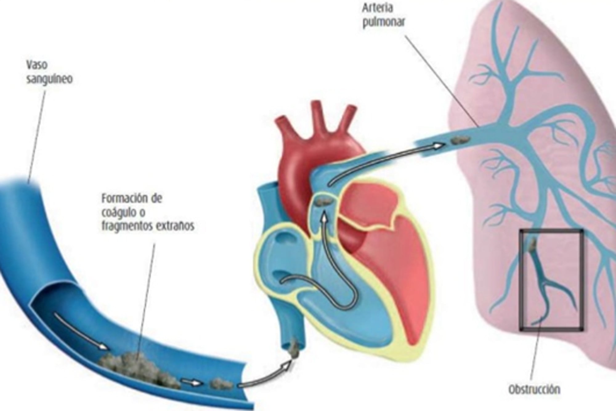 Cuando migra hacia los pulmones, suele aparecer disnea (falta de aire repentina), taquicardia, dolor torácico o dolor dorsal