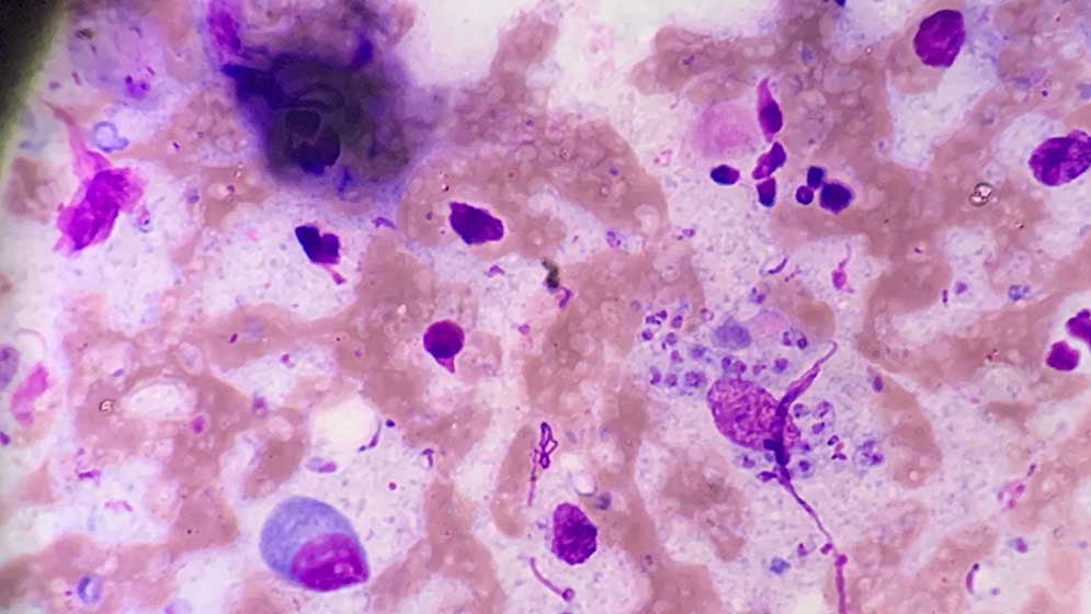 Imagen de microscopía de parásitos de Leishmania en frotis de lesión cutánea (Foto: CONICET)