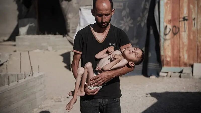 Malik Nidal Saad, de 6 años, sufre desnutrición aguda por falta de alimentos debido al bloqueo israelí. Su familia pide tratamiento urgente para salvarlo