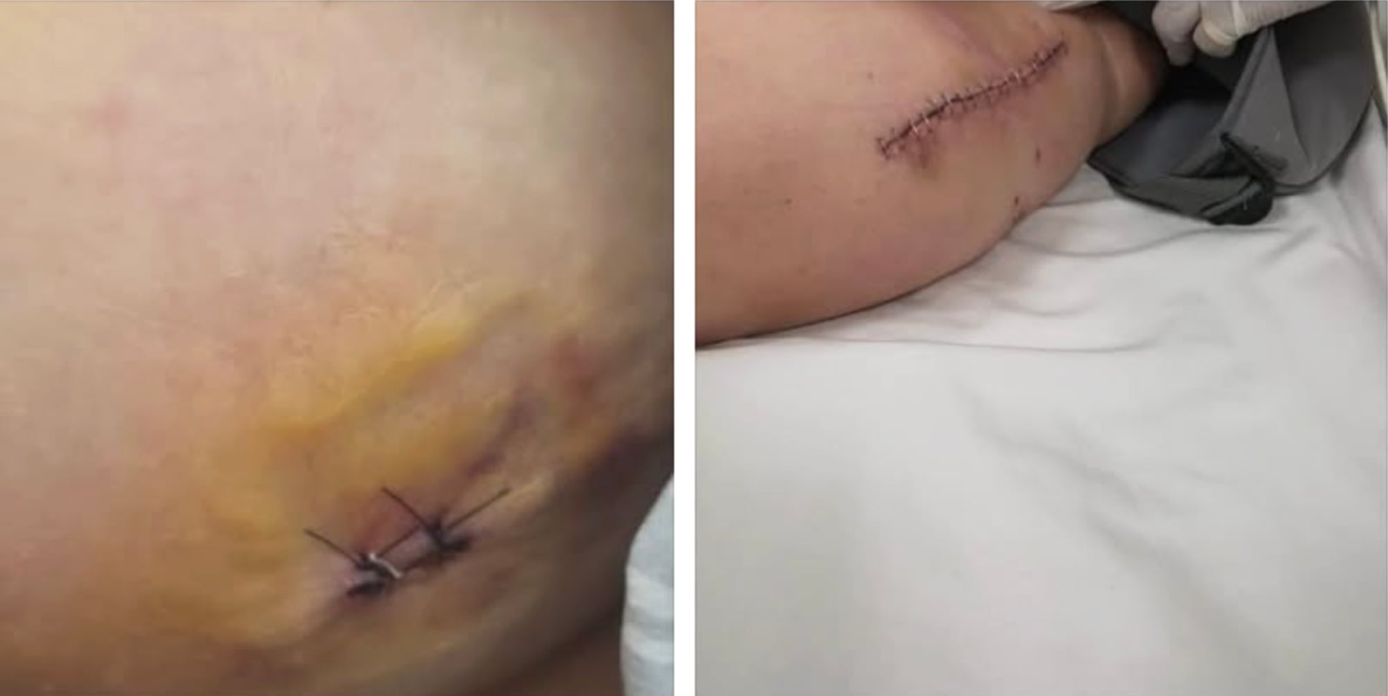 Heridas de Nadia Beller