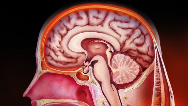 La meningitis puede estar causada por virus o bacterias y puede ser una enfermedad mortal