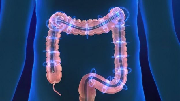Enfermedad inflamatoria intestinal: del diagnóstico cada vez más frecuente a los nuevos tratamientos para revertir el daño