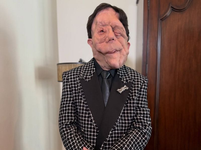 Quién es Adam Pearson, el actor con neurofibromatosis que asistió a los Premios Oscar y visibilizó su dura condición