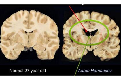 A diferencia de los que sería un cerebro normal de una persona de 27 años, el de Hernández presentaba grandes cavidades y tejido atrofiado. (Foto: Boston University)