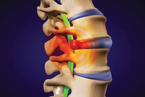 Qué es una hernia de disco lumbar y cuáles son sus síntomas