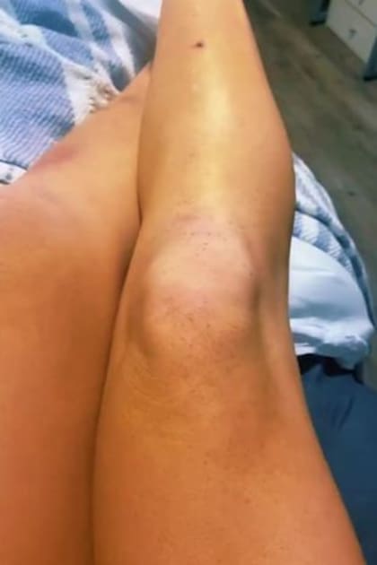 A la joven se le aparecieron extrañas pecas por todo su cuerpo