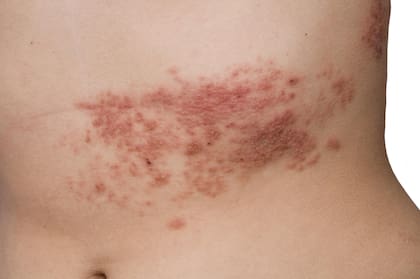 A partir de los 50 años el riesgo de sufrir "culebrilla", causada por el herpes zóster, asciende de manera considerable