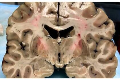 A pesar de su apariencia saludable exterior, el cerebro de Hernández estaba profundamente dañado por la encefalopatía traumática crónica. (Foto: Boston University)