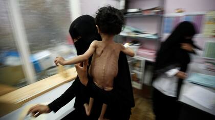 Una mujer, junto a su hijo, tras pesarlo en la unidad de cuidados intensivos del hospital de Sanaa