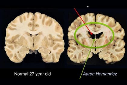El cerebro de Hernández presentaba grandes cavidades y tejido atrofiado