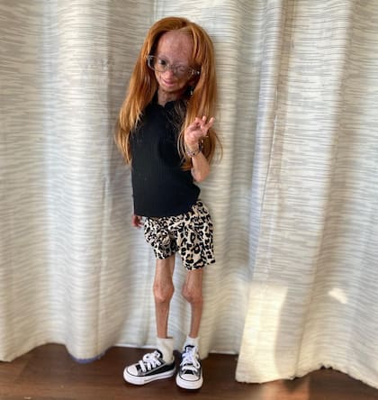 Adalia Rose, la influencer de quince años que tenía "el síndrome de Benjamin Button"