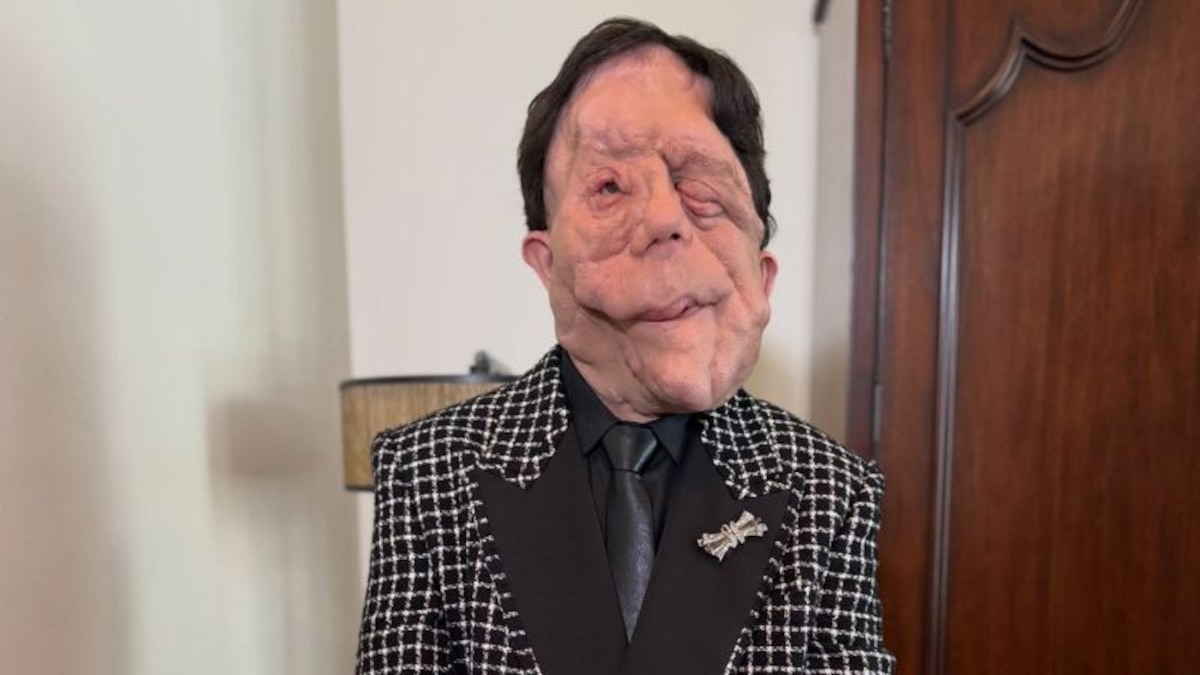 Adam Pearson: El Actor con Neurofibromatosis que Brilló en los Premios Oscar y Concientiza sobre su Condición 1 Adam Pearson: El Actor con Neurofibromatosis que Brilló en los Premios Oscar y Concientiza sobre su Condición