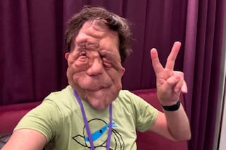 Qué es y cómo se trata la neurofibromatosis, la enfermedad que tiene el actor Adam Pearson