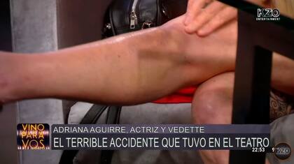 Adriana Aguirre mostró cómo le quedó la pierna a tres meses de su violenta caída en el escenario