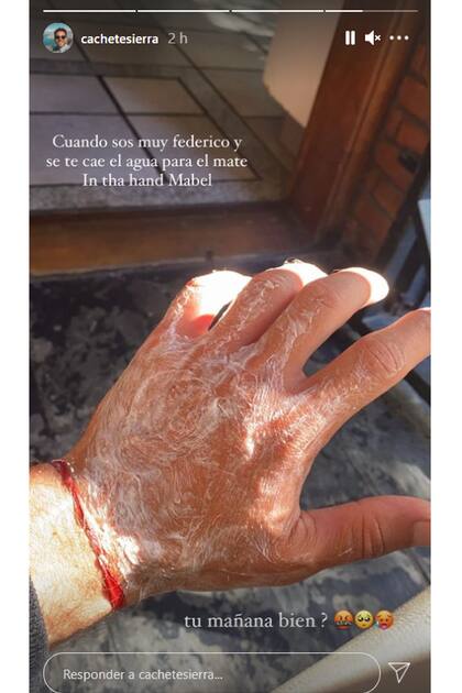 Agustín Sierra mostró la quemadura que tuvo en toda la mano por un accidente mientras cargaba el agua caliente en el termo