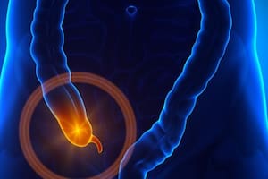 Un médico explicó por qué la apendicitis es una de las urgencias quirúrgicas más frecuentes en las guardias