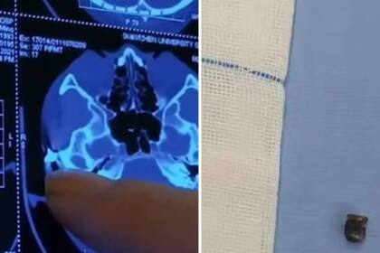 Al lado de la tomografía, la bala de aire comprimido que le extrajeron a Chen