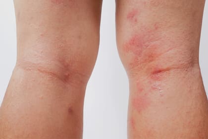 Algunas manchas rojas en la piel son provocadas por alergias