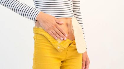 Algunas personas requieren cirugía y deben luego utilizar una bolsa de colostomía para recoger las heces