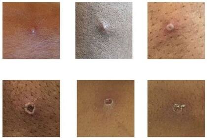 Algunos ejemplos de las lesiones de la viruela símica que pueden servir para detectar casos tempranos 