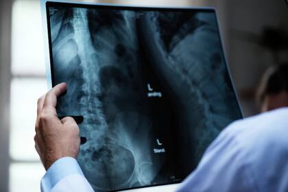 Alrededor del 25% de las fracturas osteoporóticas ocurren en varones
