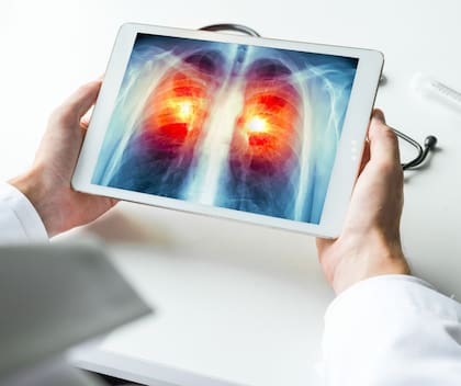 Amivantamab puede utilizarse en alrededor del 2% de los pacientes con cáncer de pulmón ya que actúa sobre una mutación específica