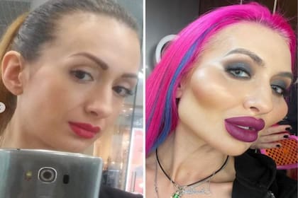 Anastasia Pokreshchuk mostró el antes y después de convertirse en la mujer con los pómulos más grandes del mundo