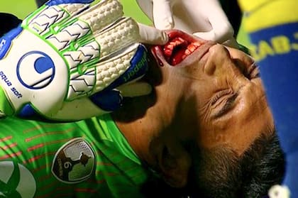 Esteban Andrada, entonces arquero de Boca, sangrante tras un choque con Dedé en la serie Boca vs. Cruzeiro de 2018.