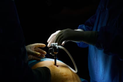 Antes de empezar, el abdomen se insufla con dióxido de carbono para crear espacio interno y facilitar el movimiento de los instrumentos