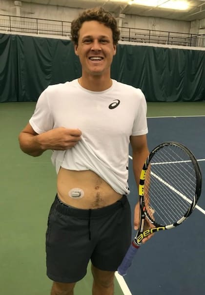 Aragone, con el parche que lo ayuda a medir su nivel de azúcar y si necesita aplicarse insulina.