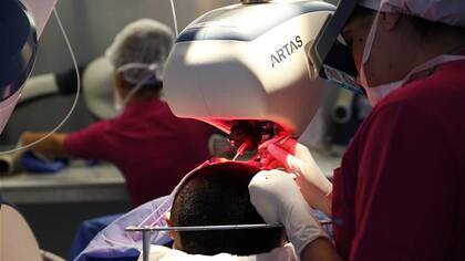El Sistema Robótico ARTAS utiliza la tecnología de orientación por imágenes para los autotrasplantes capilares.
