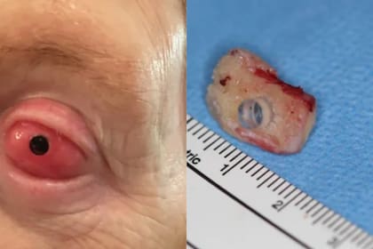 Así fue el proceso de operación ocular realizado en Vancouver