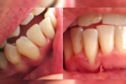 Así fue el tratamiento de Jamie (Fuente BBC)