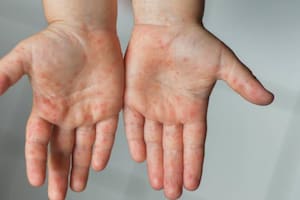 Así luce, en un principio, el sarpullido causado por la viruela del mono