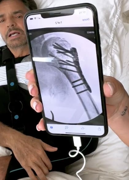 Así luce una de las placas que tiene Eugenio Derbez en su hombro