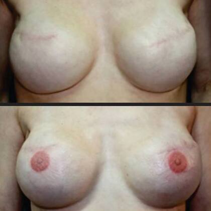 Así quedan las mamas luego del tatuaje