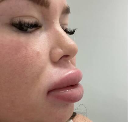 Así quedaron los labios de la joven