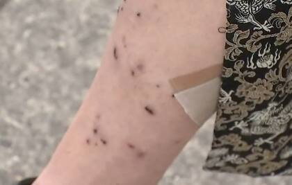 Así quedó el brazo de la afectada por las mordidas