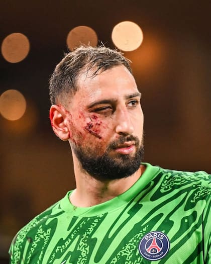 Así quedó el rostro de Donnarumma tras la falta (Foto/Instagram: @donnarumma)