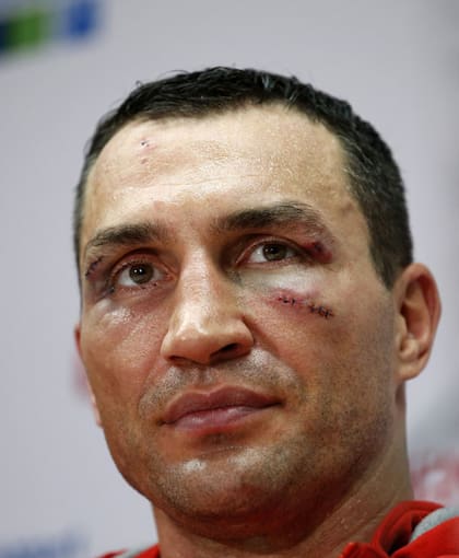 Así quedó el rostro de Klitschko tras le derrota