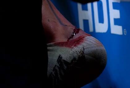 Así quedó el tobillo izquierdo de Adam Bareiro luego del pisotón de Emanuel Britez, defensor argentino de Fortaleza