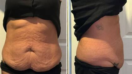 Así quedó la barriga de Charmaine tras perder 38 kilos con las inyecciones que se vendían de manera libre en el Reino Unido