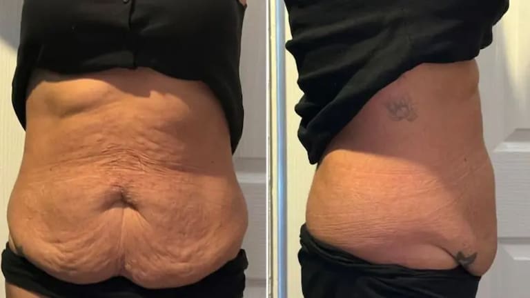 Así quedó la barriga de Charmaine tras perder 38 kilos con las inyecciones que se vendían de manera libre en el Reino Unido