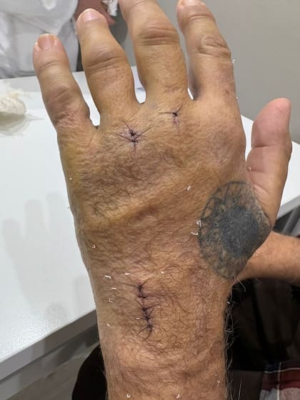 Así quedó la mano del artista tras su accidente