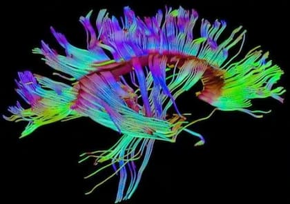 Así se ve una tractografía