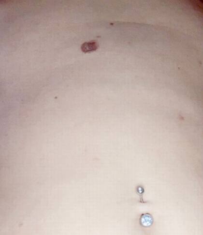 Así se veía el lunar que tuvieron que sacarle a Sharon. Se había convertido en un melanoma (Facebook)