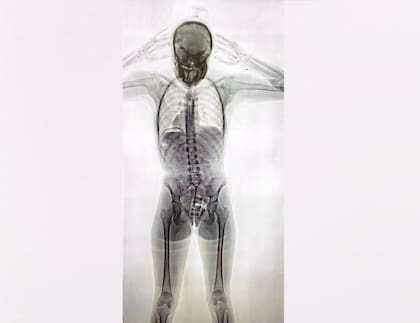 Así se veía en el escaner el cuerpo de la "mula" que llevaba 78 cápsulas de cocaína