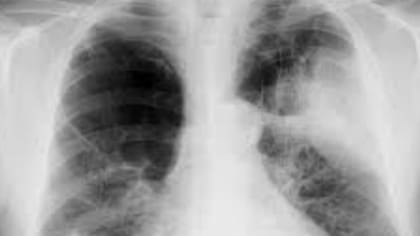 Así se ven los pulmones de un paciente con la EPOC