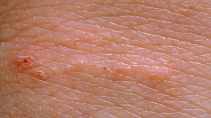 Aspecto de la sarna en la piel